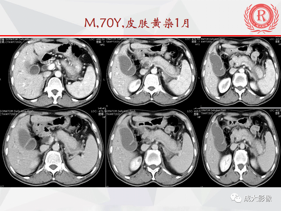 影像PPT - 【PPT】自身免疫性胰腺炎影像诊断-2