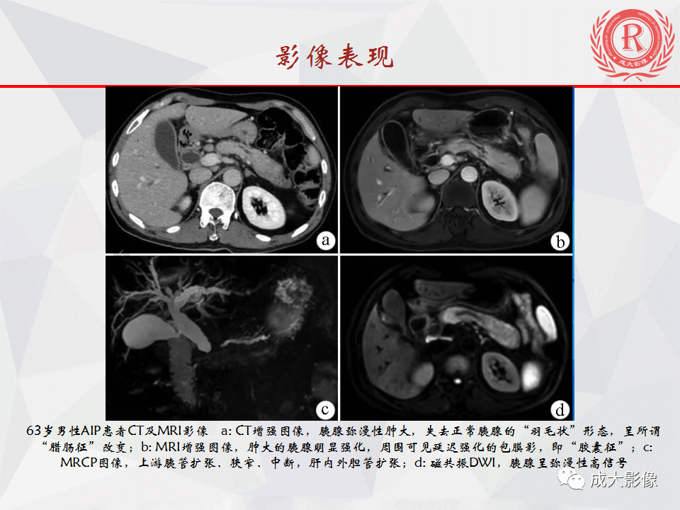 影像PPT - 【PPT】自身免疫性胰腺炎影像诊断-14