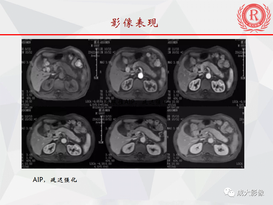 影像PPT - 【PPT】自身免疫性胰腺炎影像诊断-16