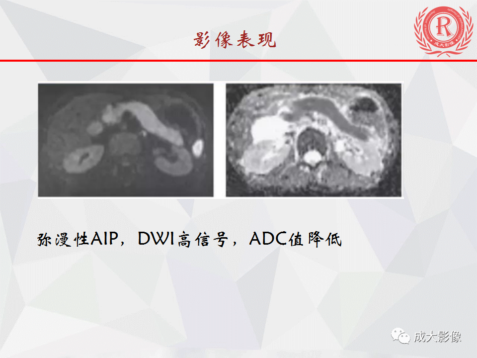 影像PPT - 【PPT】自身免疫性胰腺炎影像诊断-17