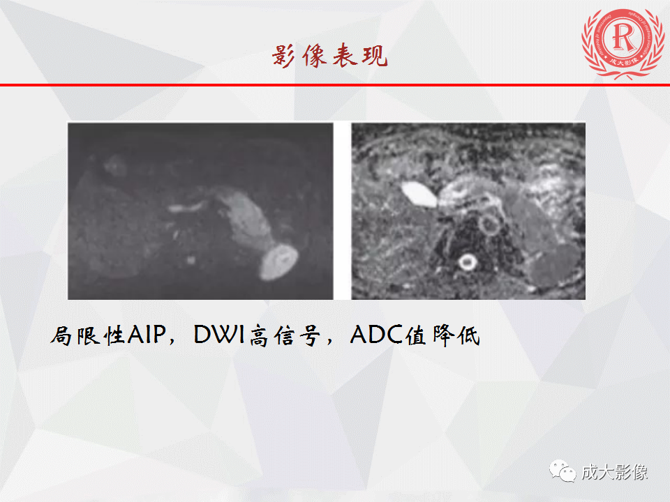 影像PPT - 【PPT】自身免疫性胰腺炎影像诊断-18