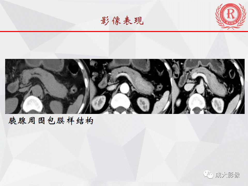 影像PPT - 【PPT】自身免疫性胰腺炎影像诊断-21