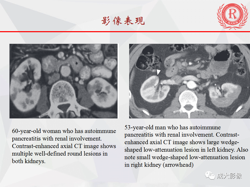 影像PPT - 【PPT】自身免疫性胰腺炎影像诊断-26