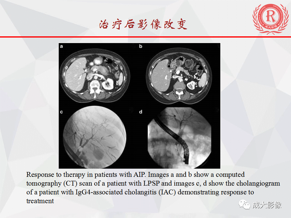 影像PPT - 【PPT】自身免疫性胰腺炎影像诊断-28