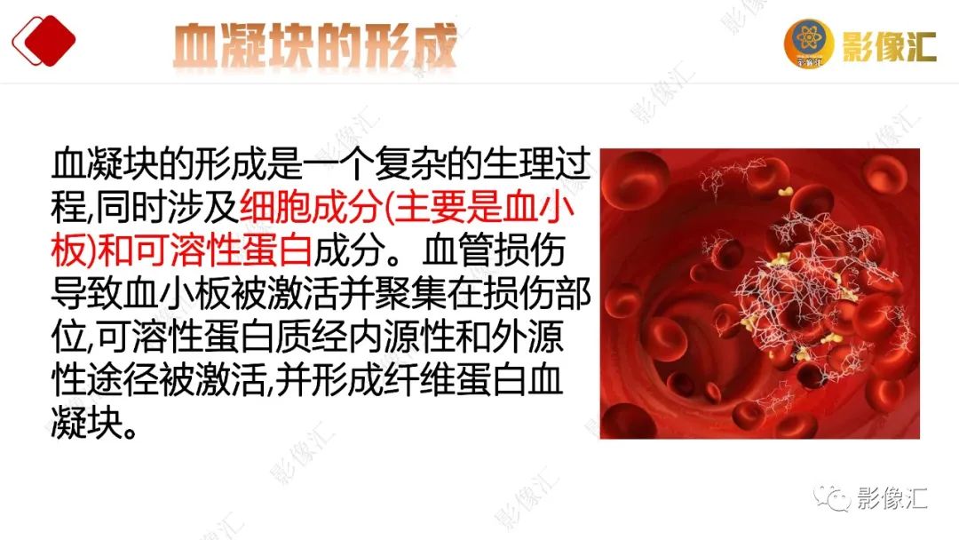 影像PPT - 【PPT】脑出血信号演变-3