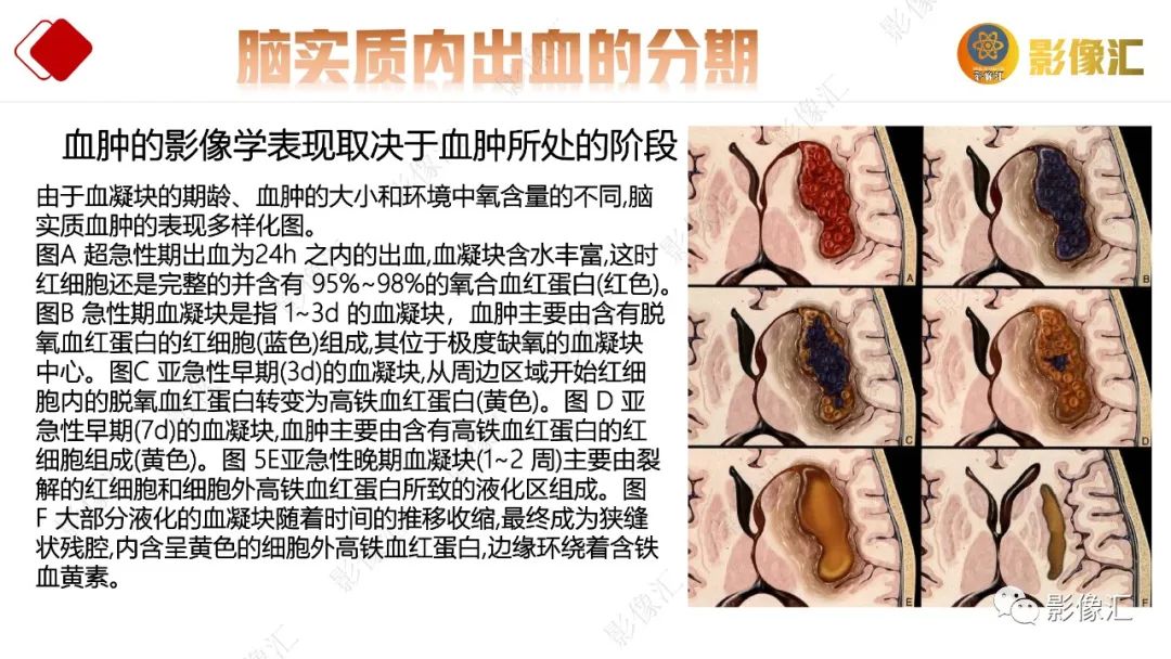 影像PPT - 【PPT】脑出血信号演变-7