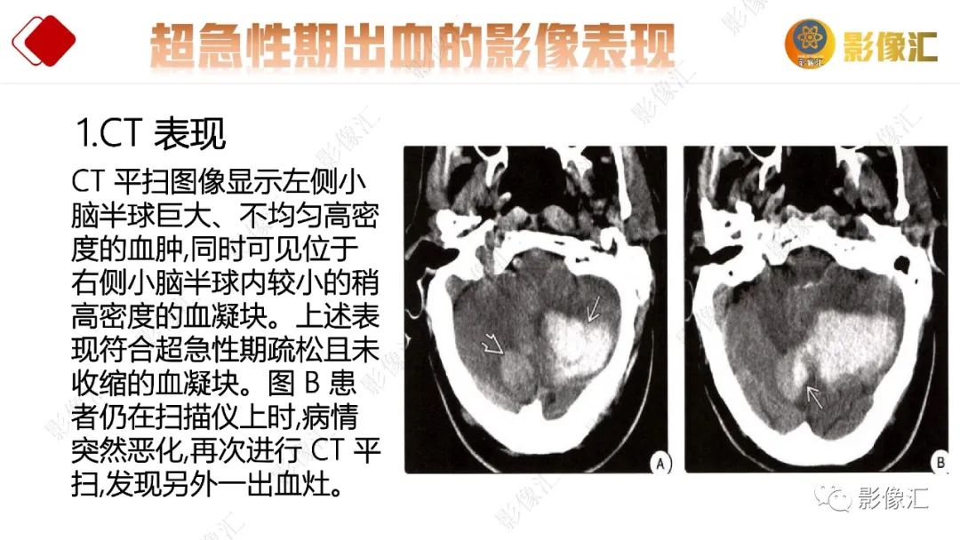 影像PPT - 【PPT】脑出血信号演变-19