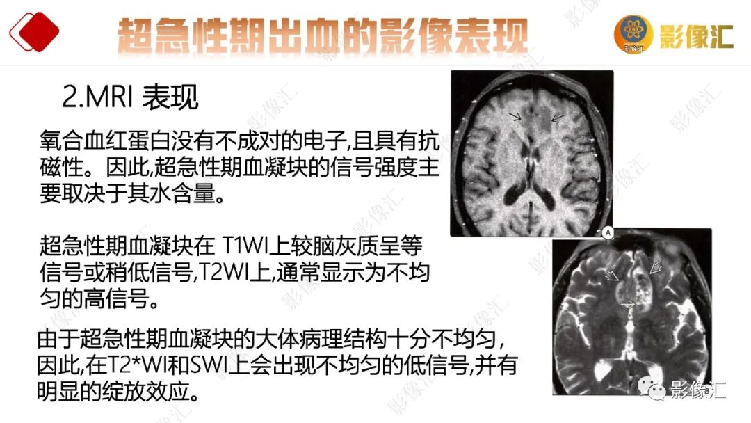 影像PPT - 【PPT】脑出血信号演变-20