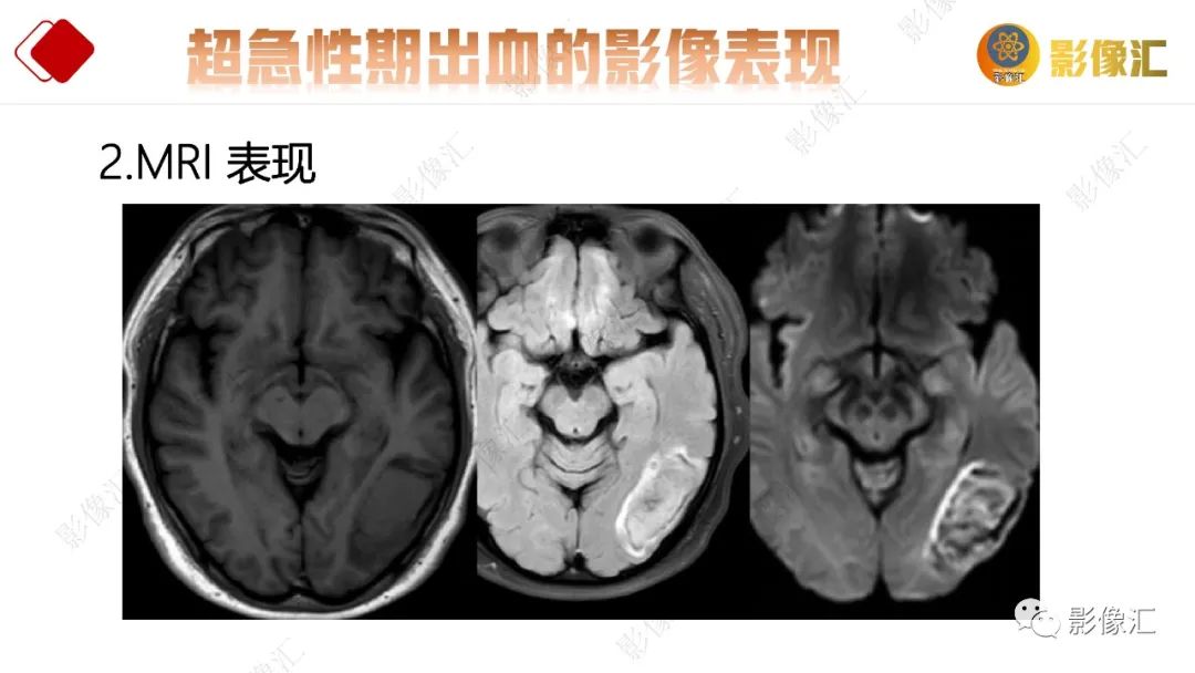 影像PPT - 【PPT】脑出血信号演变-21