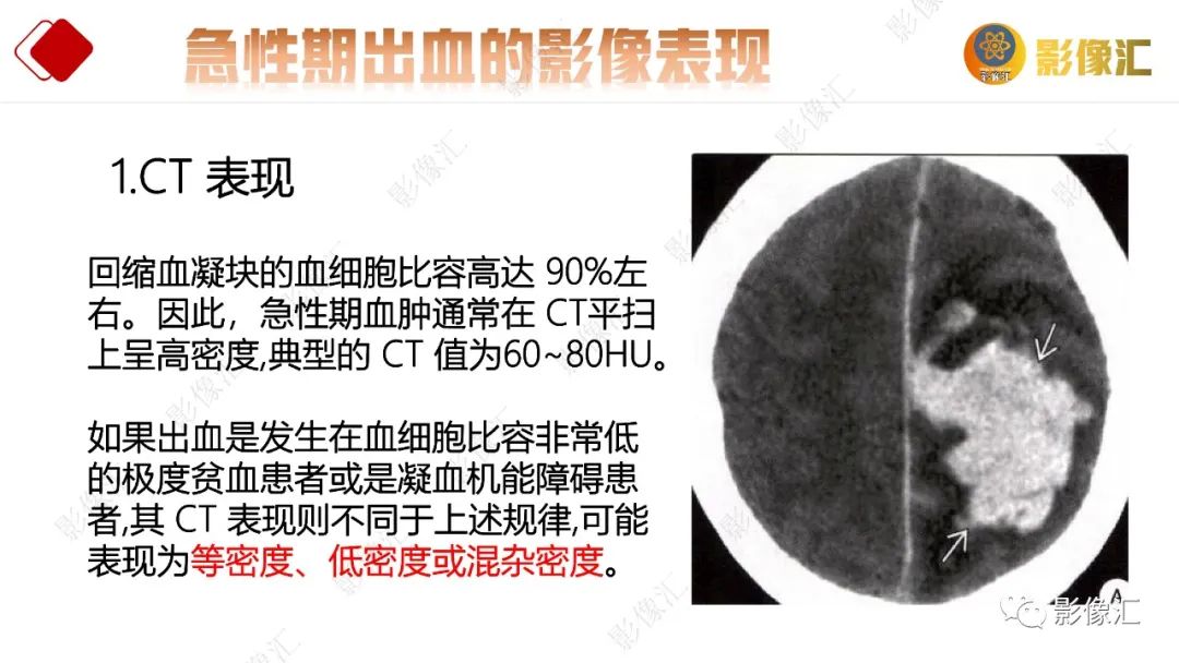 影像PPT - 【PPT】脑出血信号演变-22