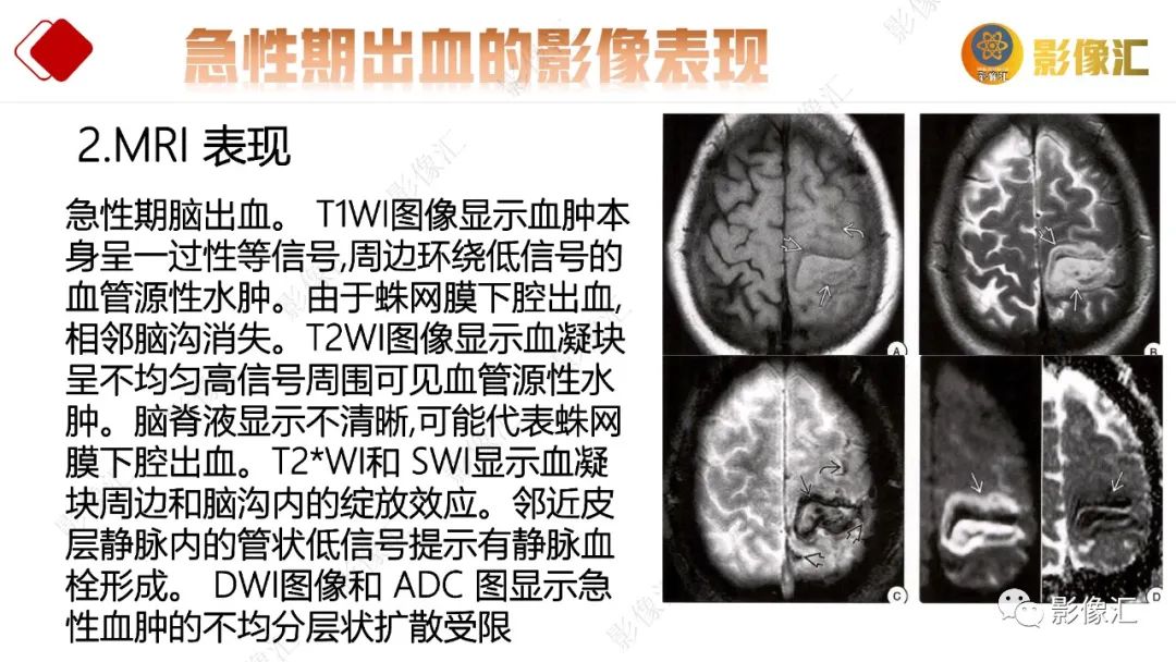 影像PPT - 【PPT】脑出血信号演变-24