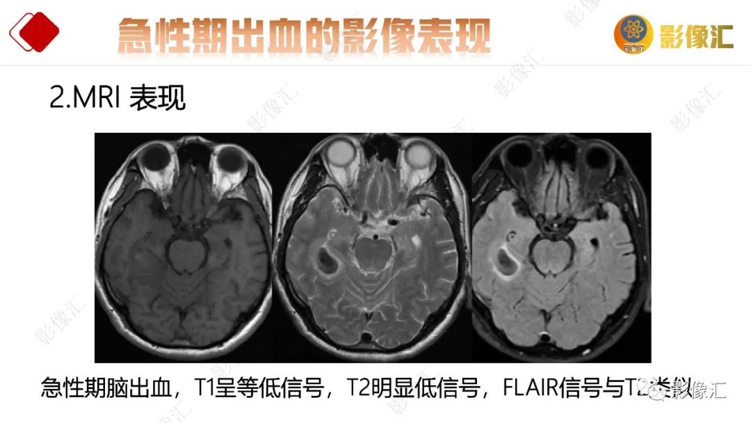 影像PPT - 【PPT】脑出血信号演变-26