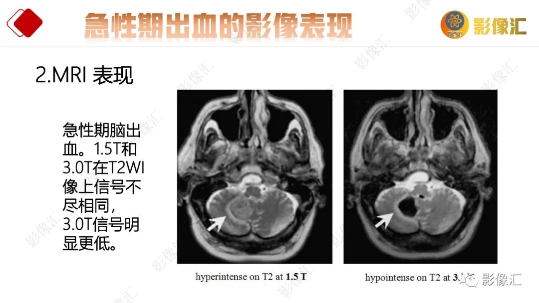 影像PPT - 【PPT】脑出血信号演变-25