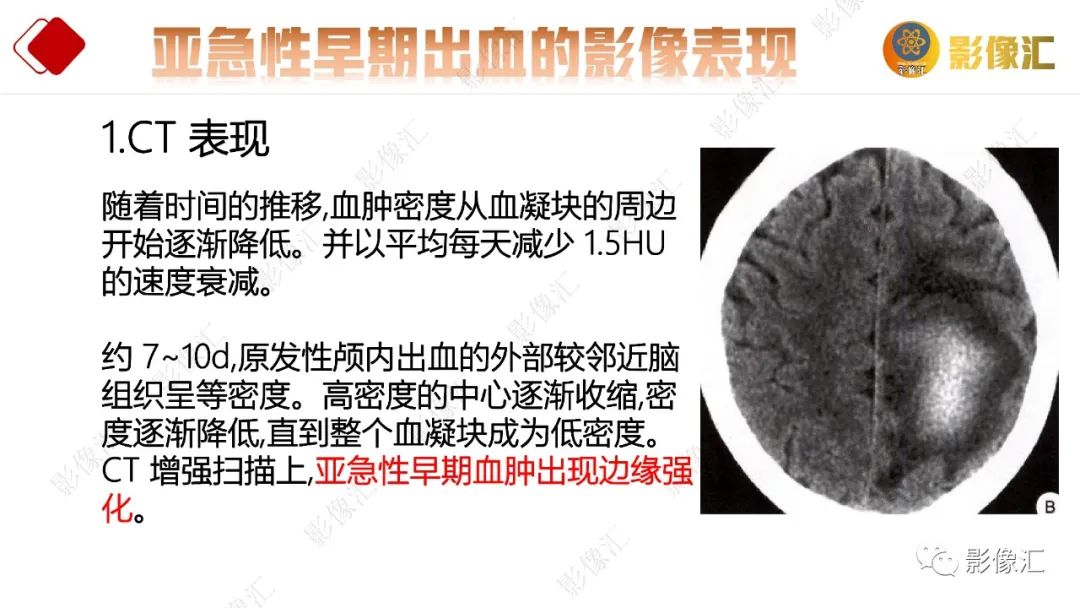 影像PPT - 【PPT】脑出血信号演变-27