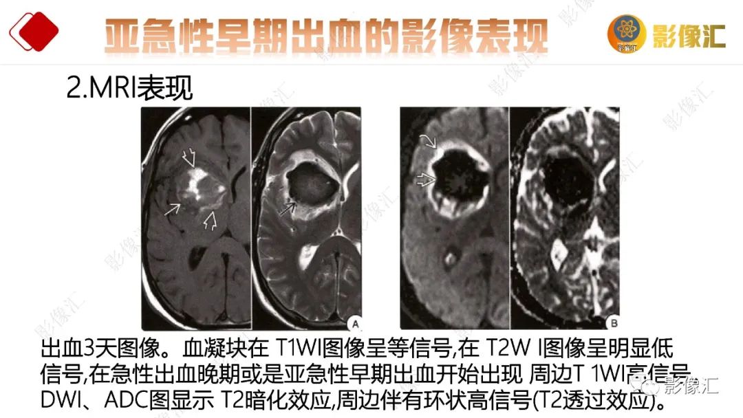 影像PPT - 【PPT】脑出血信号演变-30