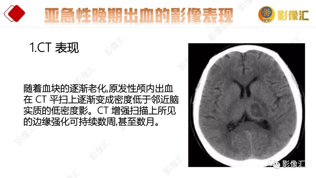 影像PPT - 【PPT】脑出血信号演变-32