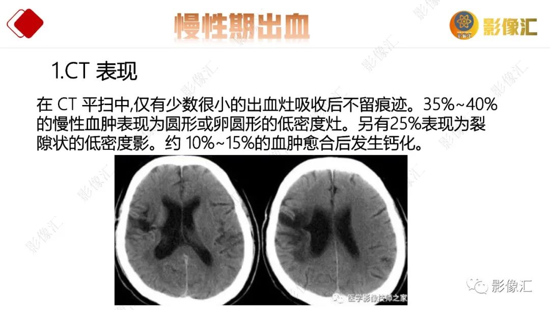 影像PPT - 【PPT】脑出血信号演变-35