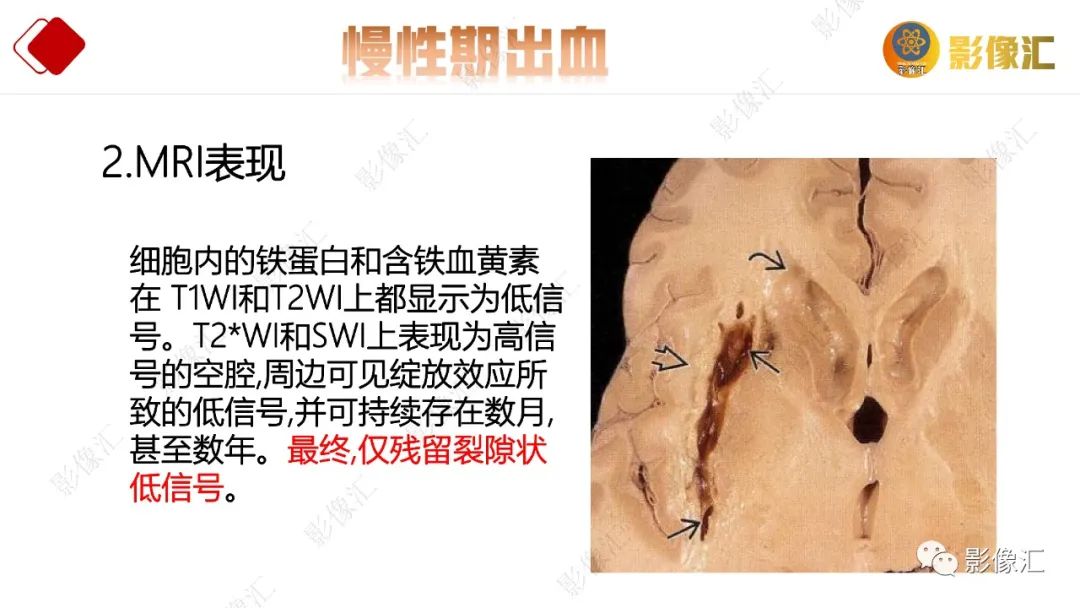 影像PPT - 【PPT】脑出血信号演变-36