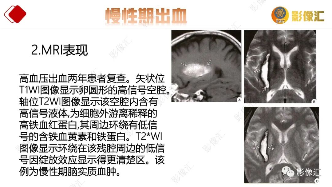 影像PPT - 【PPT】脑出血信号演变-37