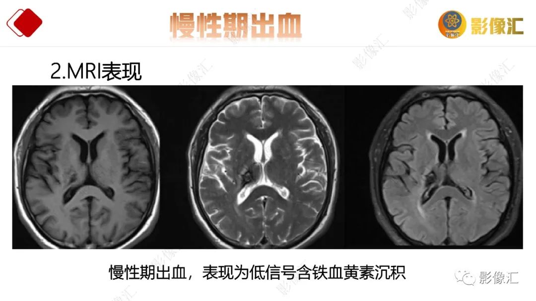 影像PPT - 【PPT】脑出血信号演变-38