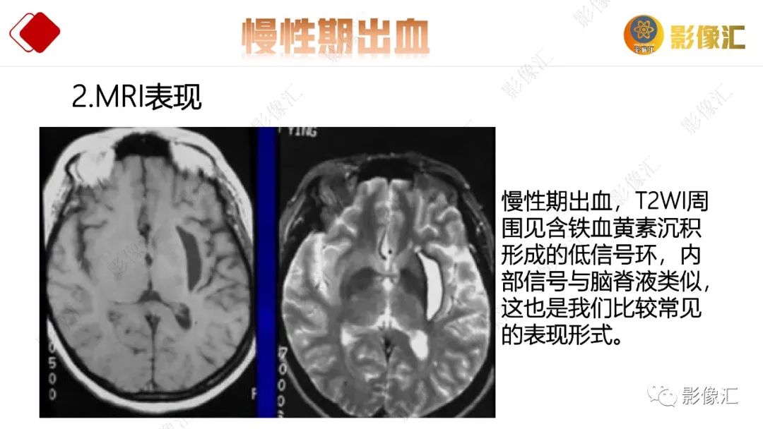 影像PPT - 【PPT】脑出血信号演变-39