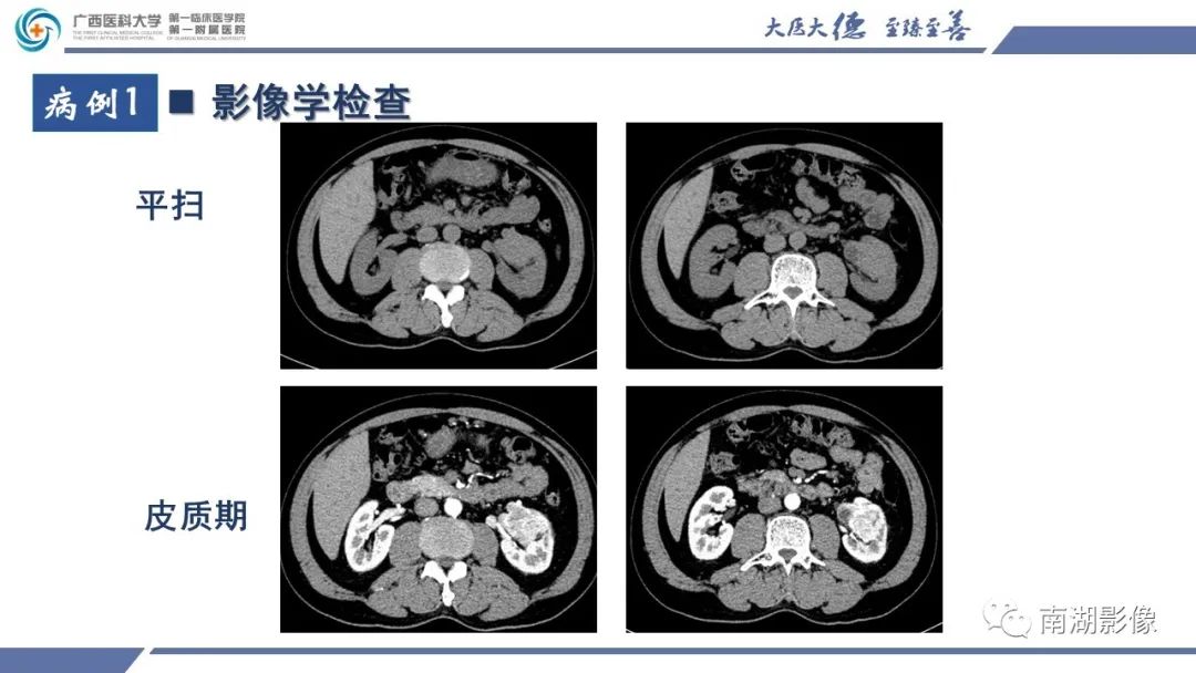 影像PPT - 【PPT】肾上皮样血管平滑肌脂肪瘤-3
