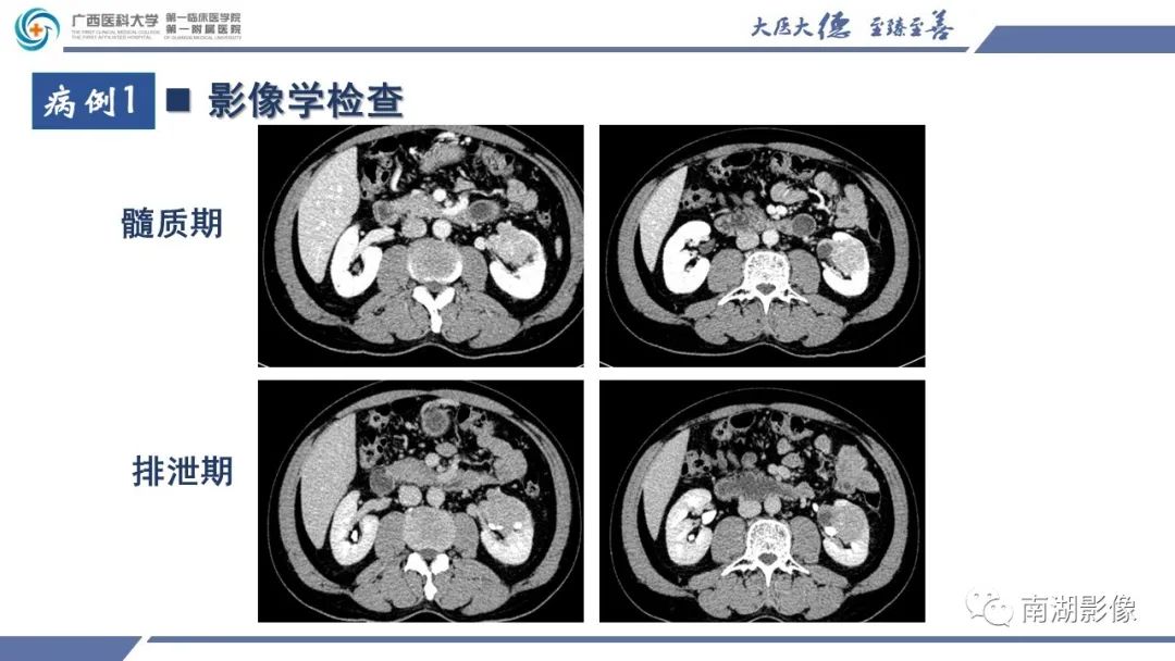影像PPT - 【PPT】肾上皮样血管平滑肌脂肪瘤-4