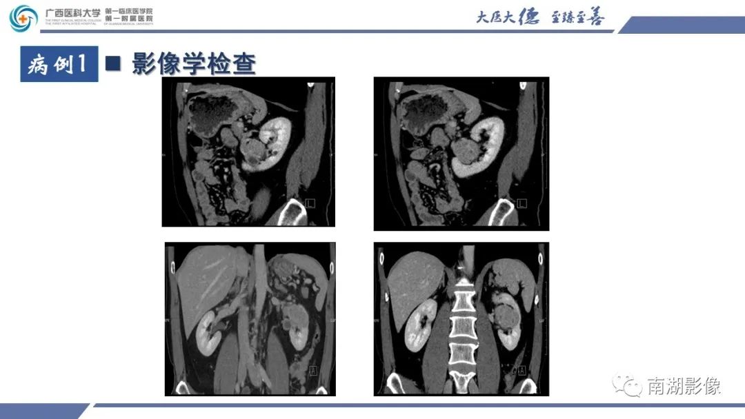影像PPT - 【PPT】肾上皮样血管平滑肌脂肪瘤-5