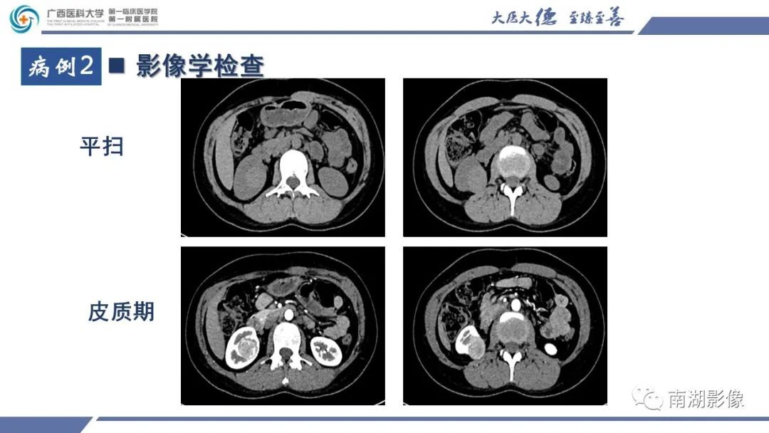 影像PPT - 【PPT】肾上皮样血管平滑肌脂肪瘤-7
