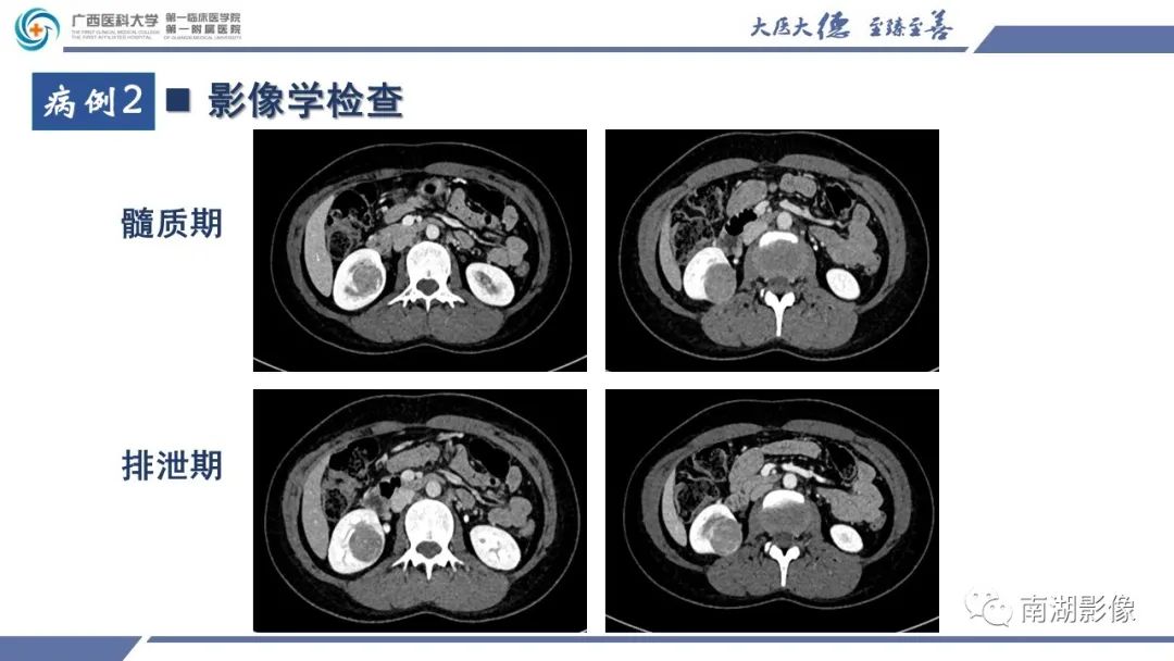 影像PPT - 【PPT】肾上皮样血管平滑肌脂肪瘤-8