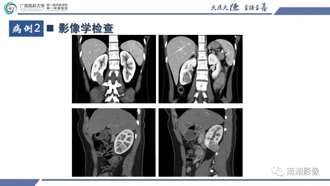 影像PPT - 【PPT】肾上皮样血管平滑肌脂肪瘤-9