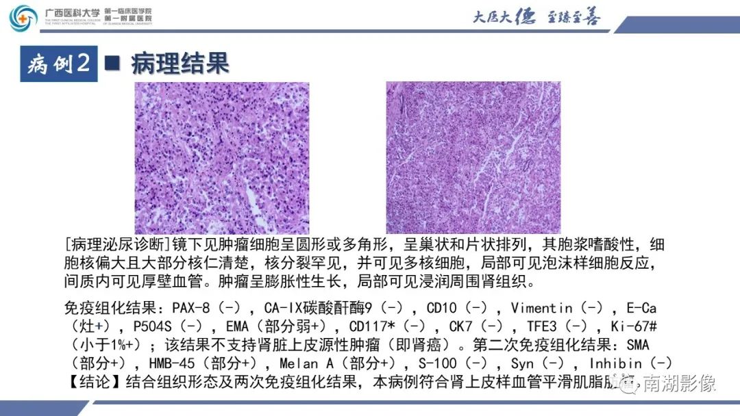 影像PPT - 【PPT】肾上皮样血管平滑肌脂肪瘤-11