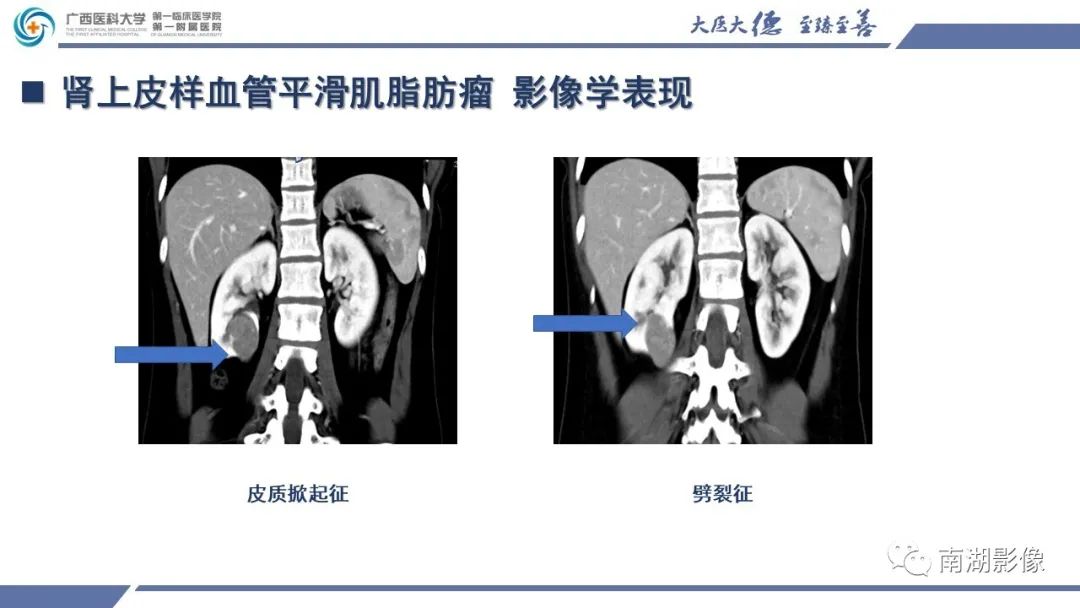 影像PPT - 【PPT】肾上皮样血管平滑肌脂肪瘤-16