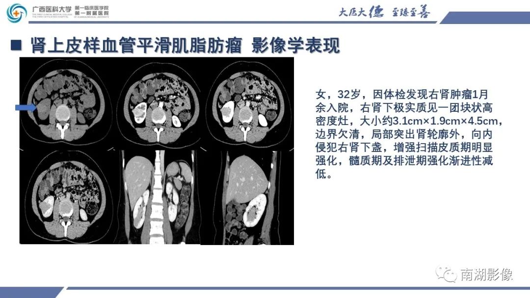 影像PPT - 【PPT】肾上皮样血管平滑肌脂肪瘤-17