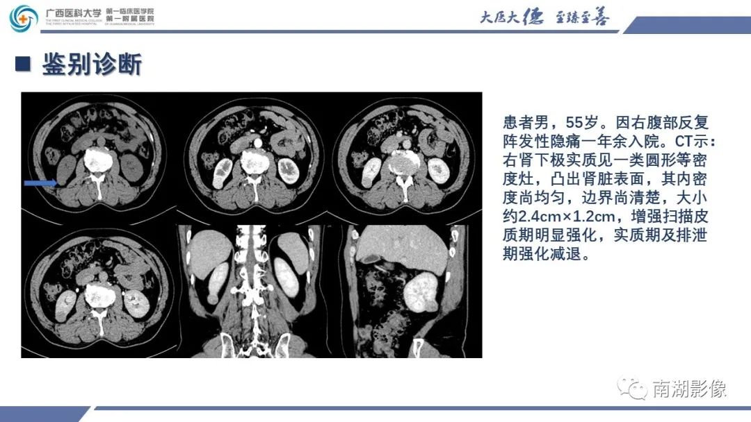 影像PPT - 【PPT】肾上皮样血管平滑肌脂肪瘤-19