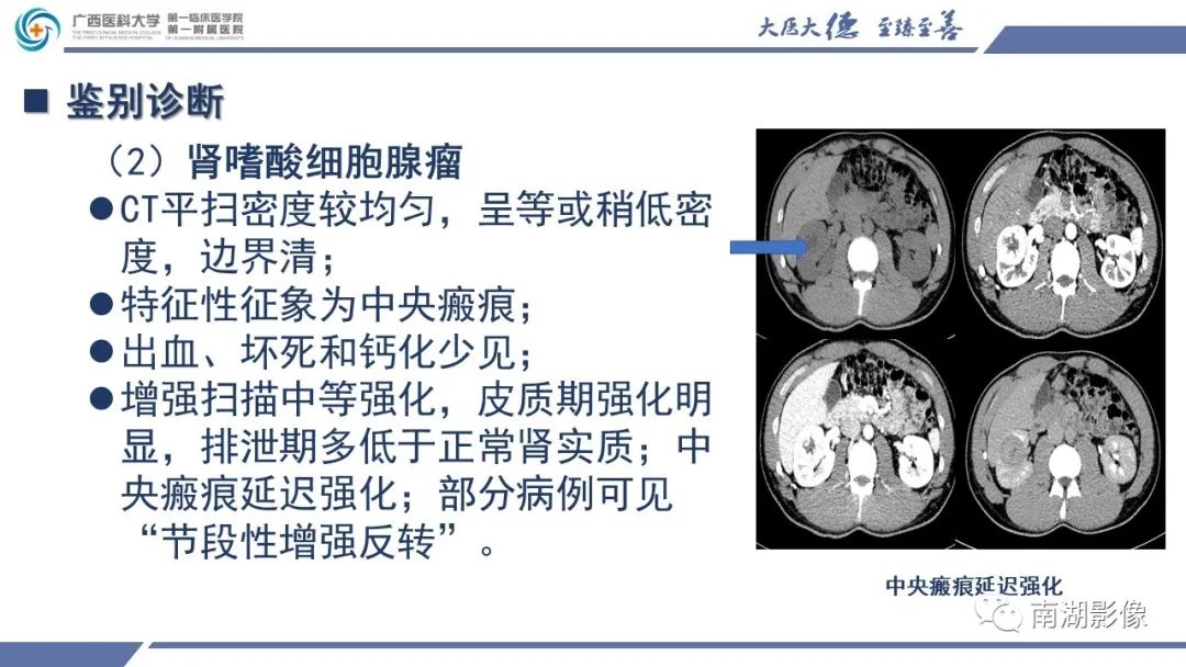 影像PPT - 【PPT】肾上皮样血管平滑肌脂肪瘤-20