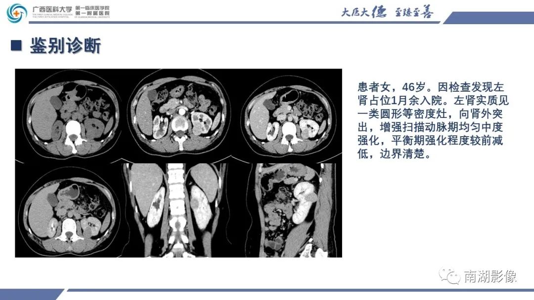 影像PPT - 【PPT】肾上皮样血管平滑肌脂肪瘤-21