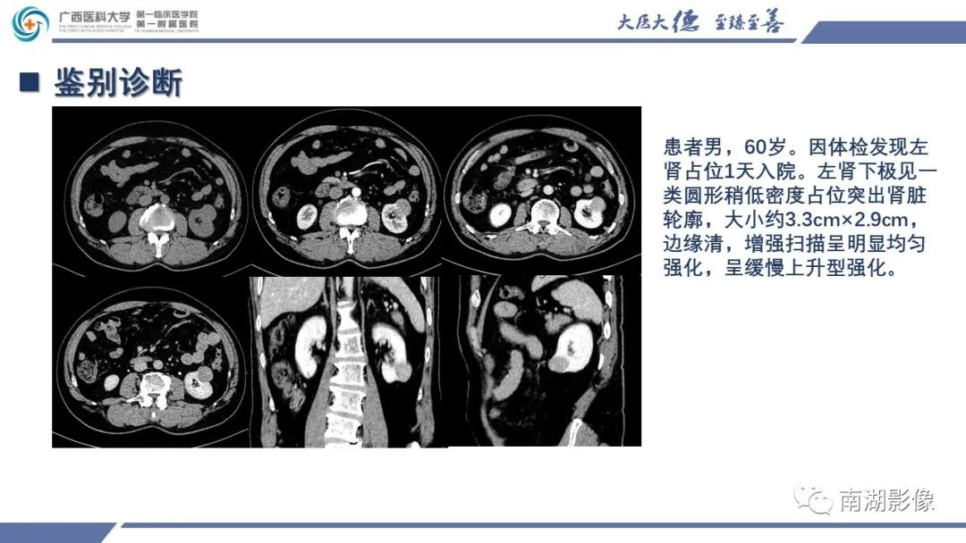 影像PPT - 【PPT】肾上皮样血管平滑肌脂肪瘤-23