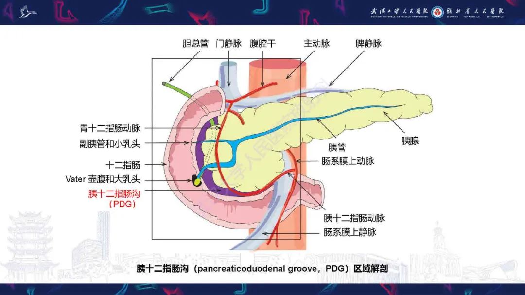影像PPT - 【PPT】胰十二指肠沟病变影像诊断-3