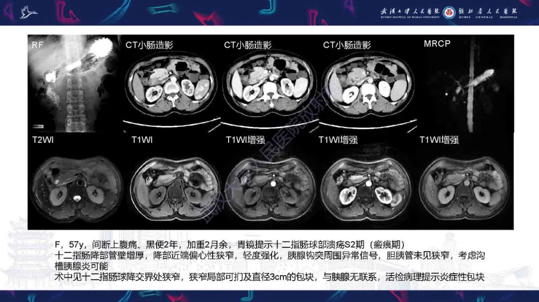 影像PPT - 【PPT】胰十二指肠沟病变影像诊断-2
