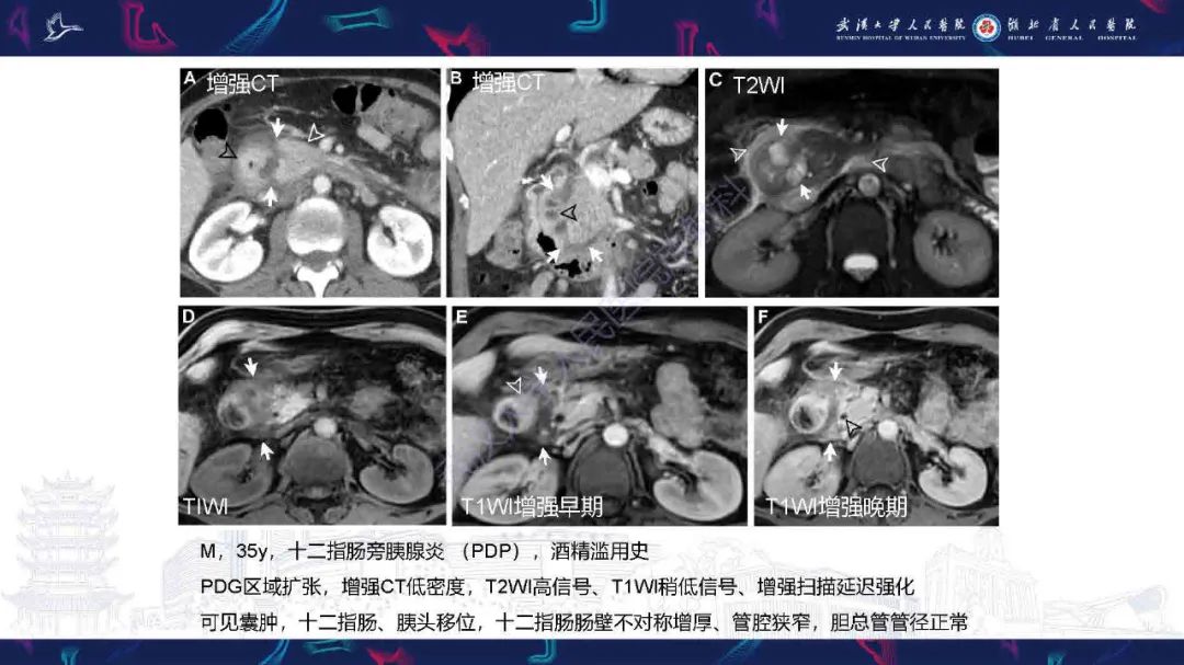 影像PPT - 【PPT】胰十二指肠沟病变影像诊断-6