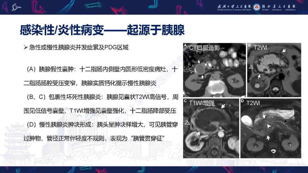 影像PPT - 【PPT】胰十二指肠沟病变影像诊断-7