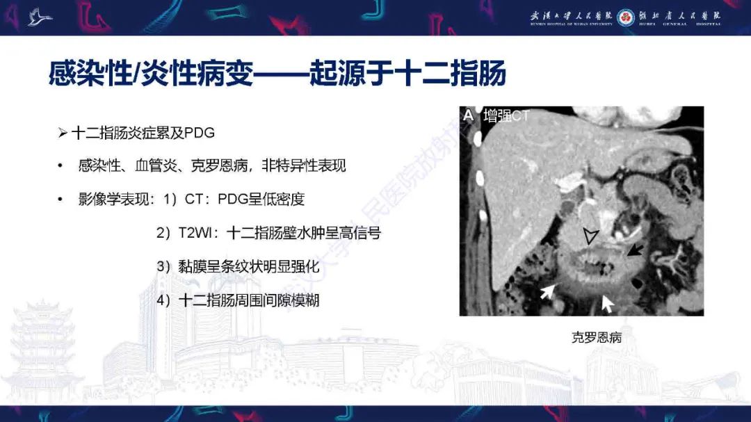 影像PPT - 【PPT】胰十二指肠沟病变影像诊断-8