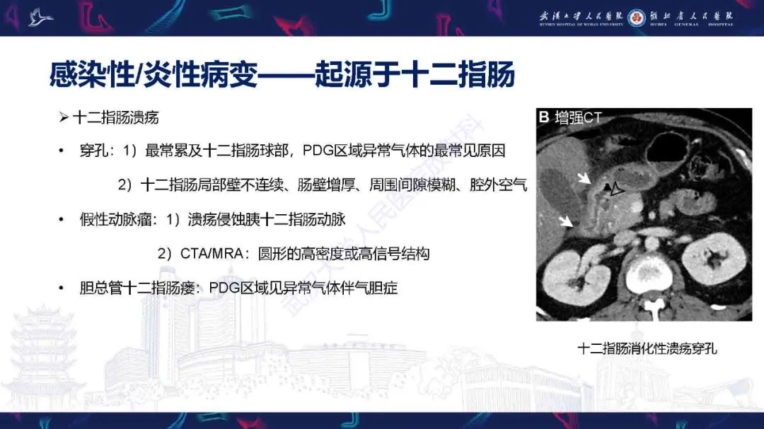 影像PPT - 【PPT】胰十二指肠沟病变影像诊断-9