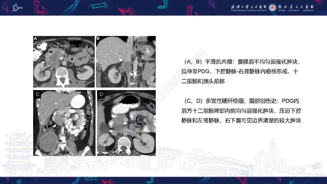 影像PPT - 【PPT】胰十二指肠沟病变影像诊断-12