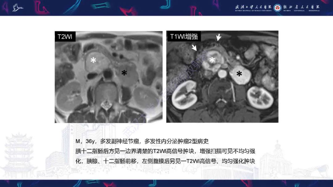 影像PPT - 【PPT】胰十二指肠沟病变影像诊断-14