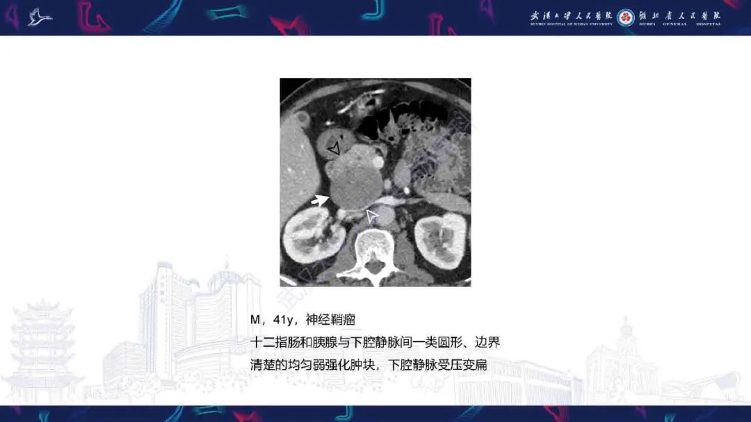 影像PPT - 【PPT】胰十二指肠沟病变影像诊断-16