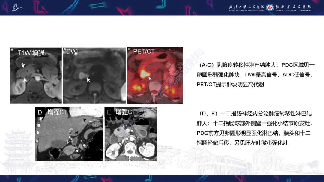 影像PPT - 【PPT】胰十二指肠沟病变影像诊断-18