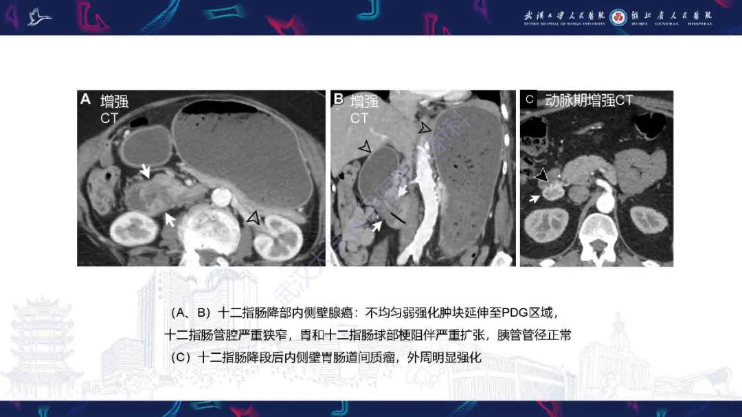 影像PPT - 【PPT】胰十二指肠沟病变影像诊断-24