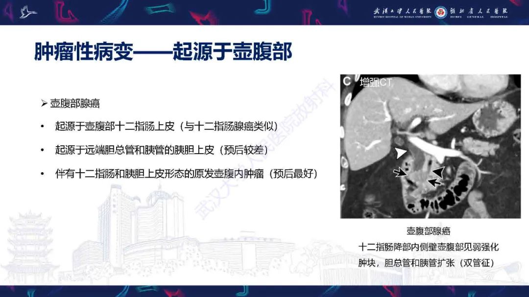 影像PPT - 【PPT】胰十二指肠沟病变影像诊断-26
